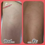 Viditeľné zlepšenie po sklerotizácii – dokumentácia ambulancie liečby kŕčových žíl