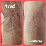 Pred liečbou a počas kontroly – vývoj žilových problémov