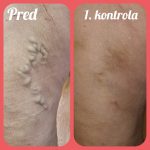Pokročilé žilové ochorenie – pred a po ošetrení na klinike Košice