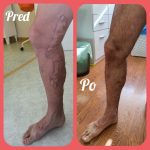 Varixy a stav po prvej kontrole – dokumentácia liečby