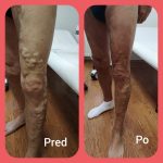 Výrazné varixy – stav pred a po zákroku