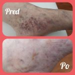 Pokročilá fáza žilového ochorenia – terapeutické výsledky
