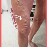 Stav nôh so žilovými zmenami – terapia v cievnej ambulancii Košice